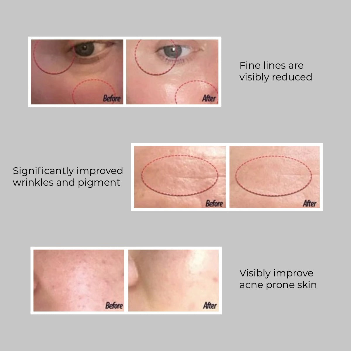 LUXE Micro-Infusion Kit
