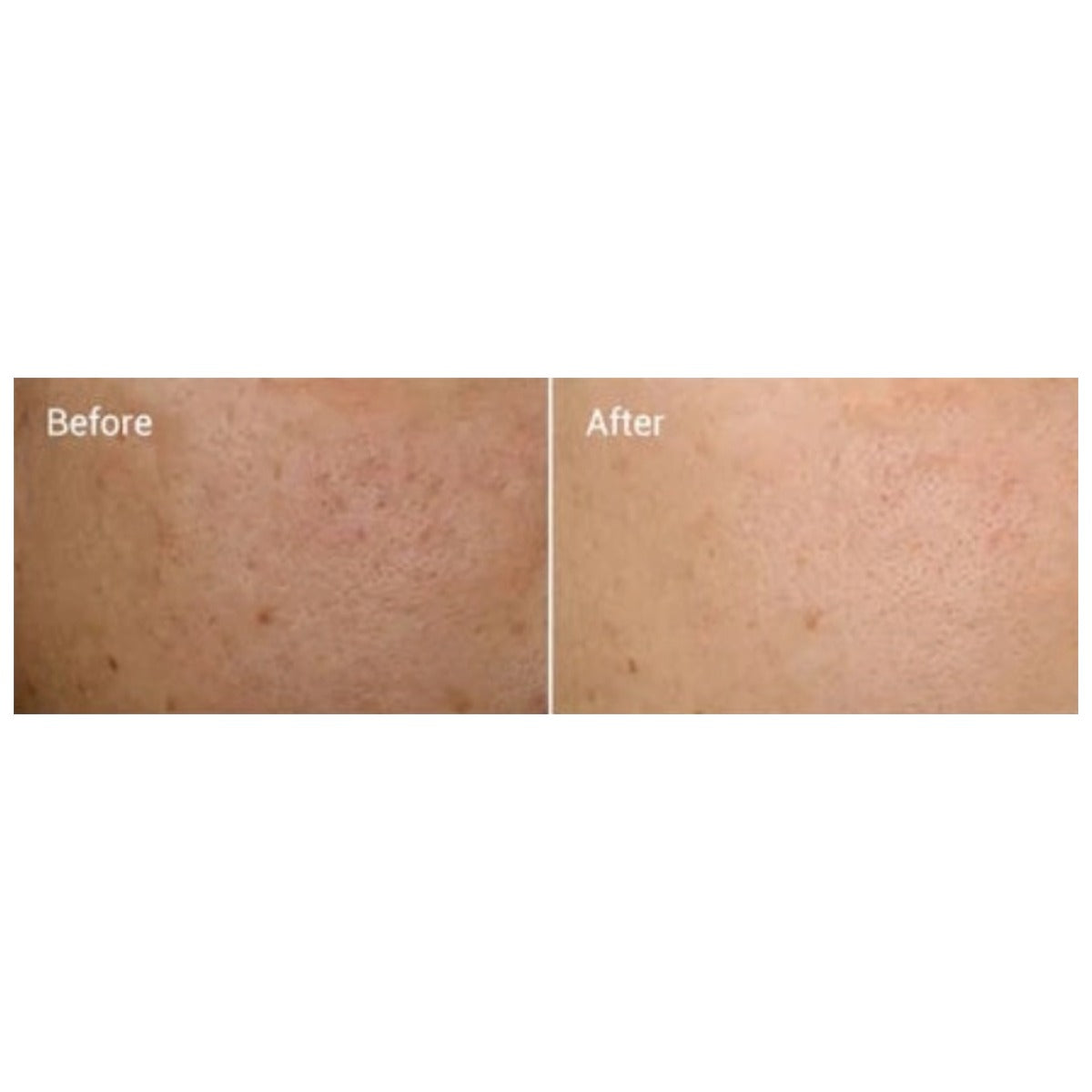 LUXE Micro-Infusion Kit